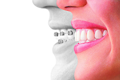 clear aligner